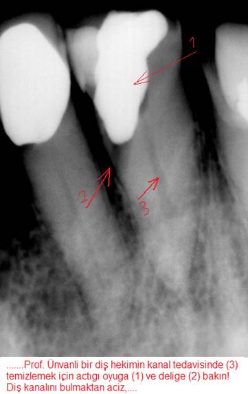 Discilik fakltesinde dis kanal tedavis-B